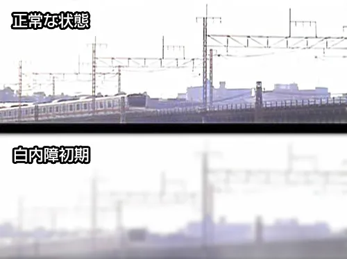 白内障の症状