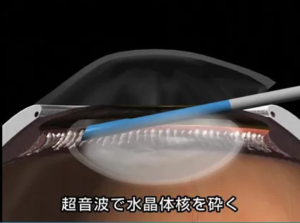 白内障手術について
