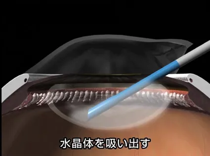 白内障手術について