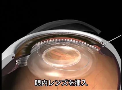 白内障手術について