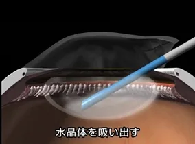 日帰り白内障手術