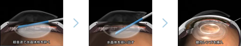 白内障手術について