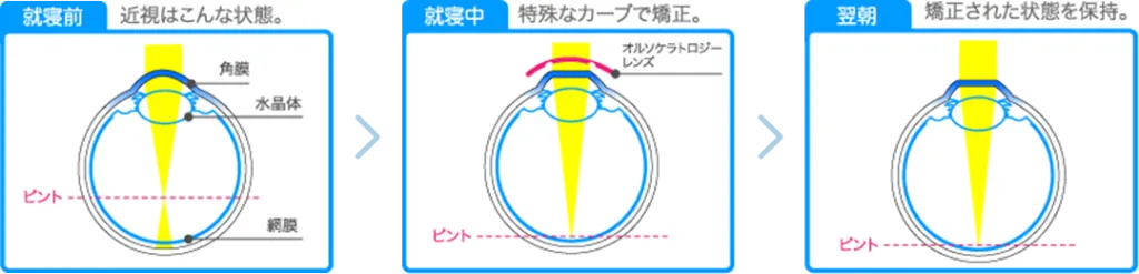 オルソケラトロジーのメカニズム